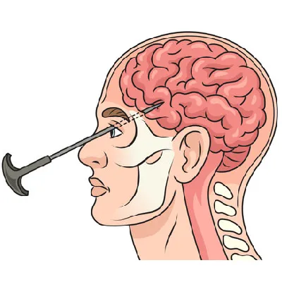 Instant Lobotomy(respawn)